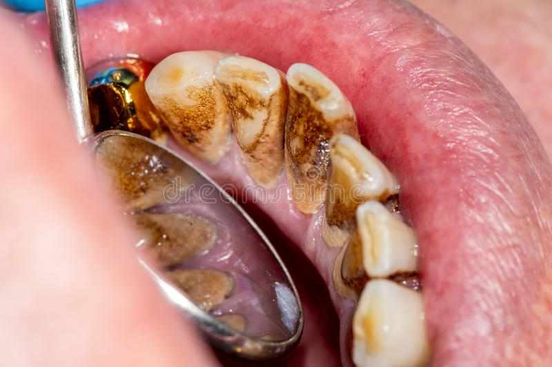 From Theory to Practice The Calculus Bridge in Dentistry