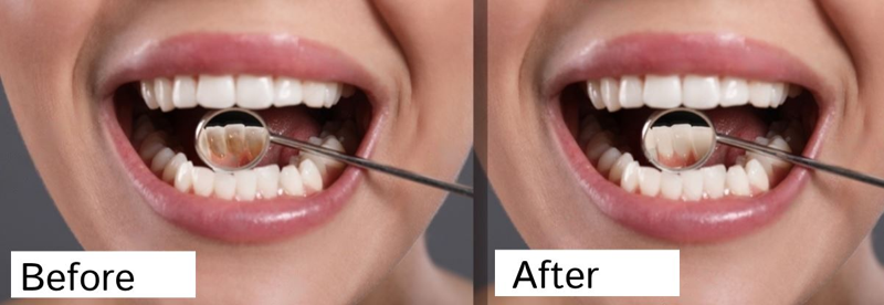 The Impact of Calculus Bridge on Dental Health What You Need to Know