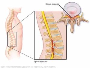 10 Effective Ways to Alleviate Spinal Stenosis Symptoms: A Comprehensive Guide