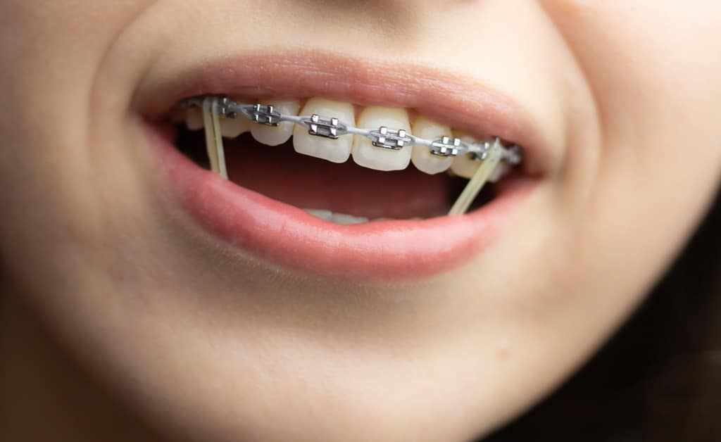 Your Smile is Our Priority: Boca Raton’s Most Trusted Orthodontics for All Ages