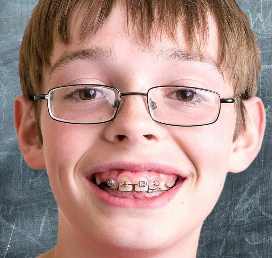 Improve Your Smile with Bismarck Braces at Hometown Orthodontics