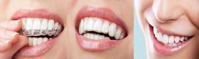 Invisalign: The New Way To A Straight Smile In Burr Ridge
