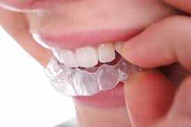 Reasons to Opt for Baltimore County Invisalign California Based parties