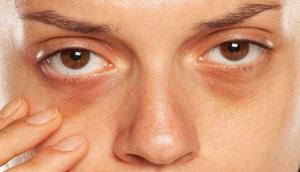 An Overview of Dark Circles & Related Aspects