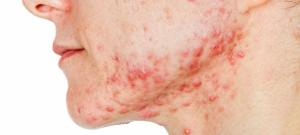 How Can Acne Be Treated? Learn Dermatologically Approved Treatments