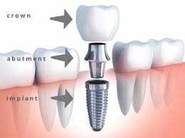 Dental Implants El Dorado: How to Grow Your Practice with Local Help By Dental Implant Club