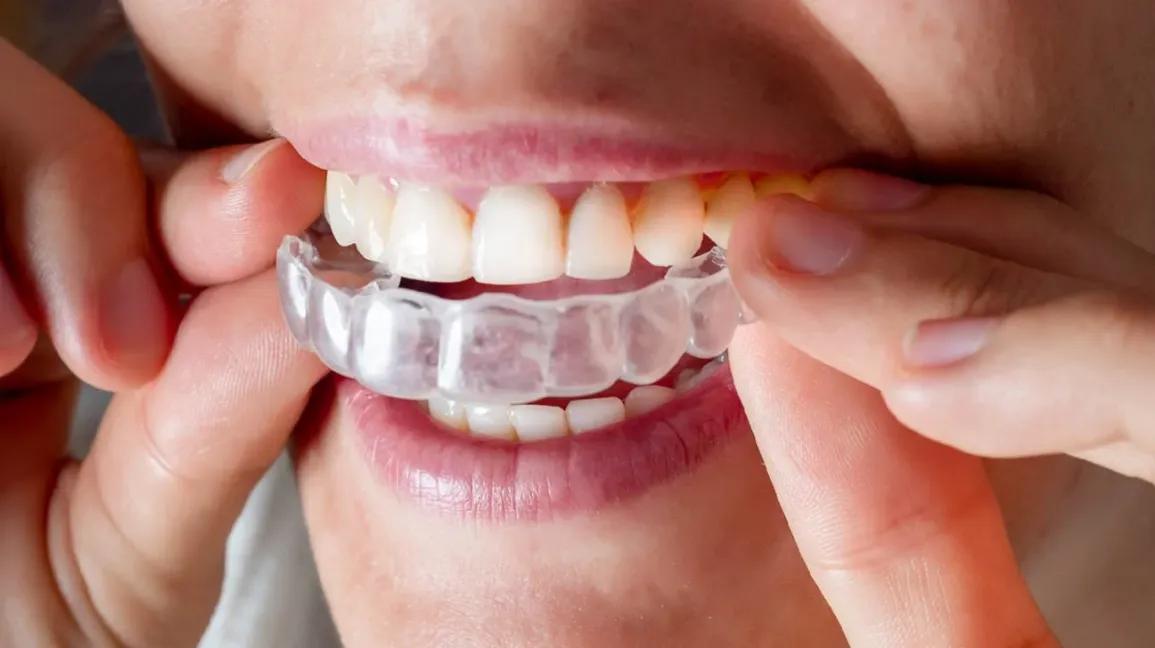 Invisalign Rochester NY