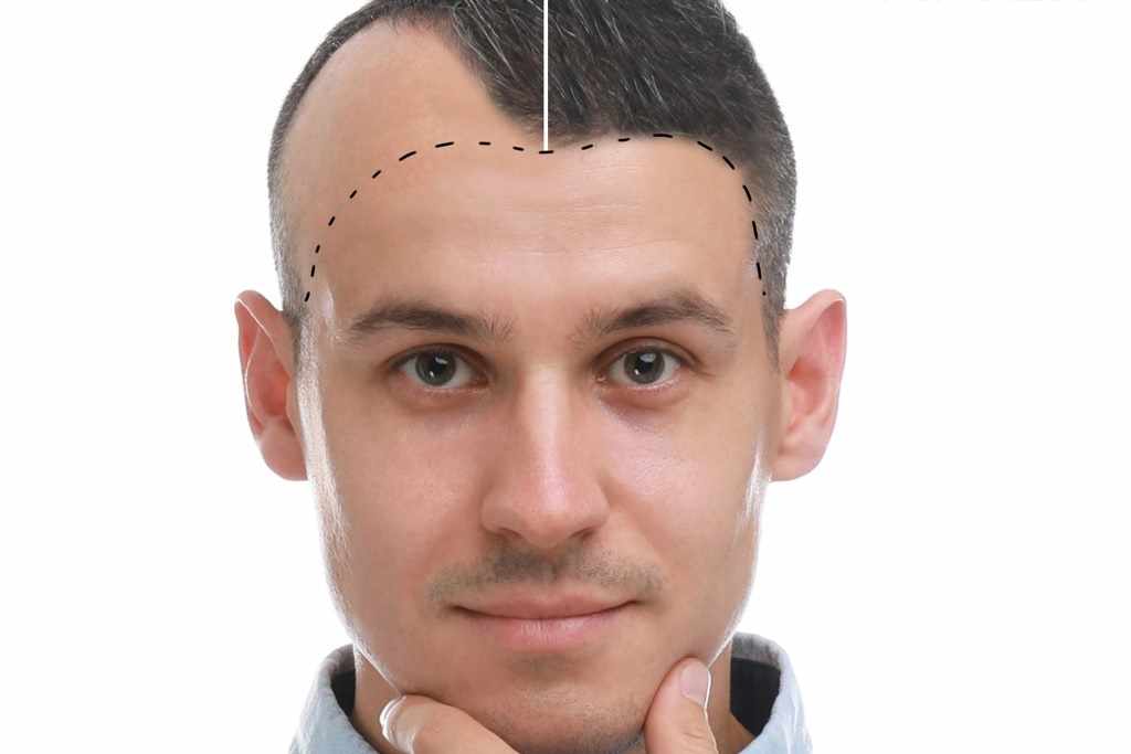Regain Your Confidence: Hair Transplant and Eyebrow Restoration in Chennai