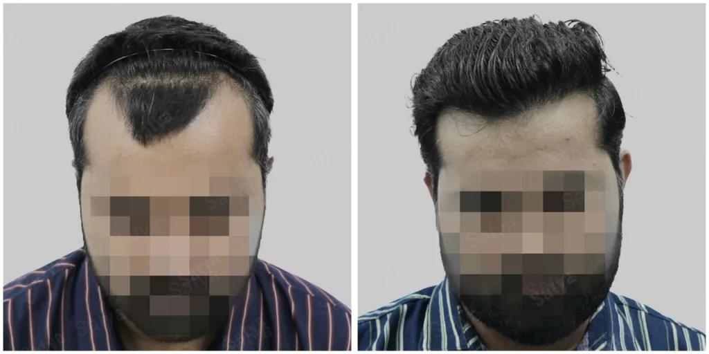 Your Premier Choice for Hair Transplants in Ahmedabad