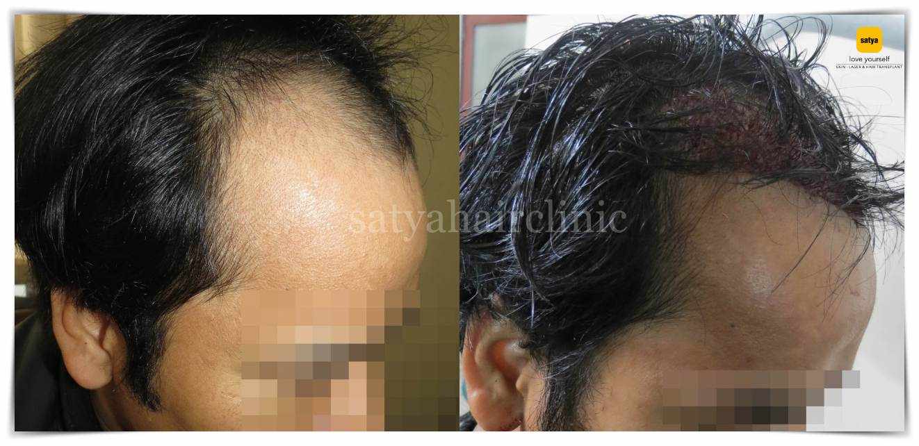 Your Premier Choice for Hair Transplants clinic in Ahmedabad