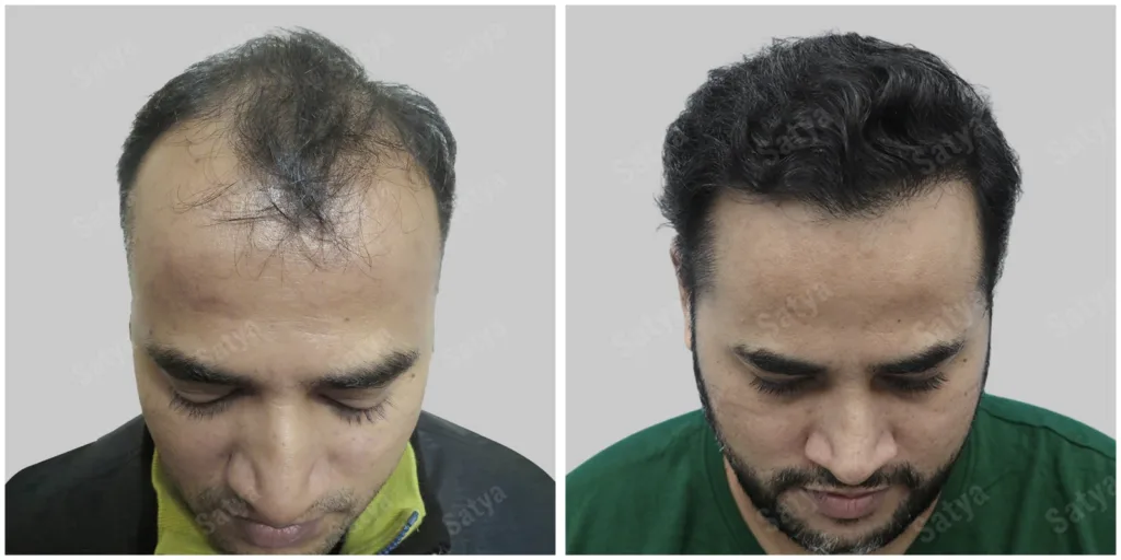 Transform Your Look: The Ultimate Guide to Hair Transplant in Chennai and Long Hair Transplant