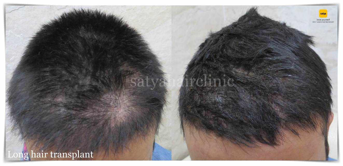 Best Hair Restoration at Satya Hair Solutions in Gurgaon