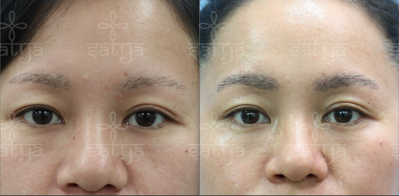 Transform Your Look with Expert Eyebrow Surgery in Delhi