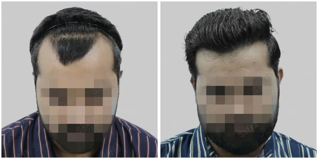 Transform Your Look with Eyebrow Hair Transplant and Hair Restoration in Gurgaon