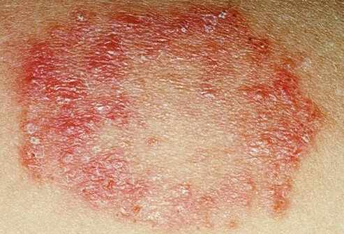 Tips for Managing Bacterial Skin Infections