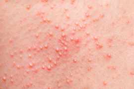 The Connection Between Skin Rashes and Allergies