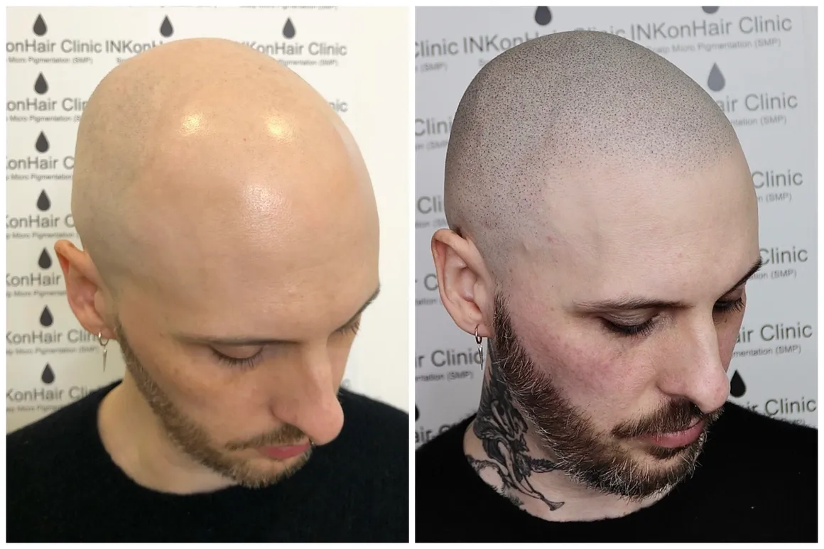 Hair Pigmentation | Advanced Solutions for Thicker | Natural-Looking Hair