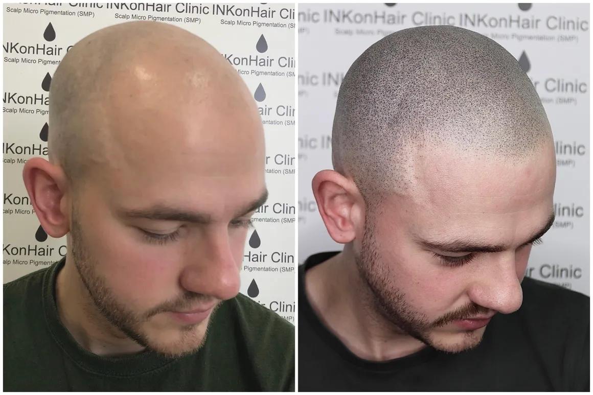 What Should You Know Before Choosing a Scalp Micropigmentation Clinic?