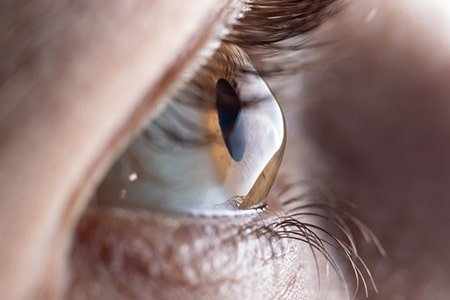 LASIK Eye Surgery Price UK: Laser Operation & Treatment Costs