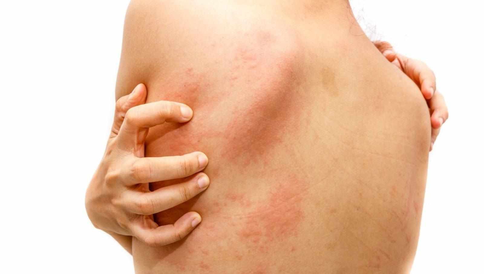 What is the best antibiotic to treat skin infections