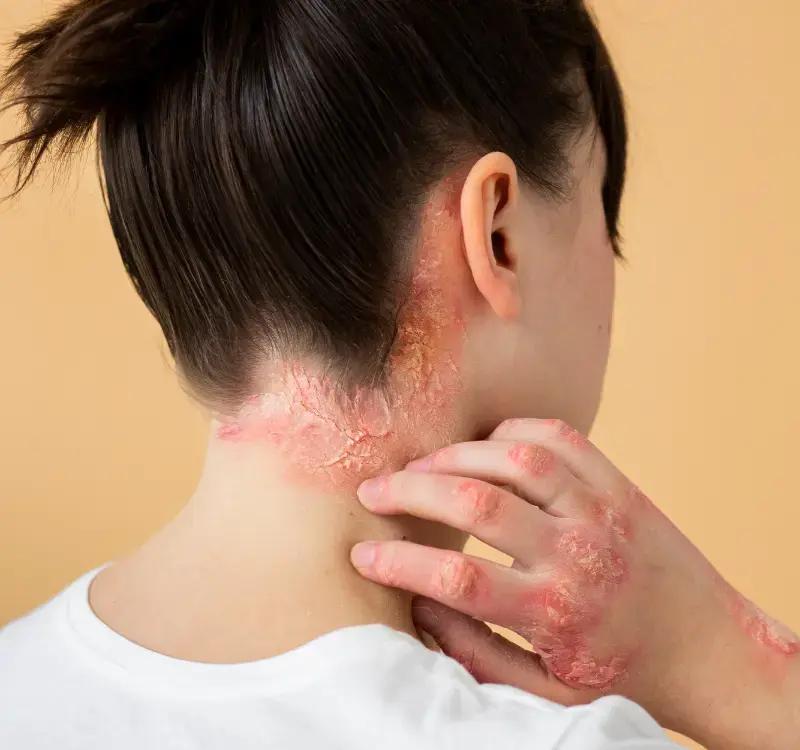 What is the best antibiotic to treat skin infections