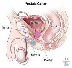 Best Prostate Cancer Treatment Doctors in India