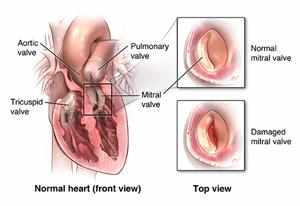 Navigating the Cost of Heart Valve Replacement Surgery in India