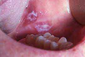 Overview-Mouth cancer