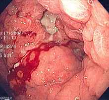 What Is Stomach Cancer? | Types of Stomach (Gastric) Cance/ Treatments 