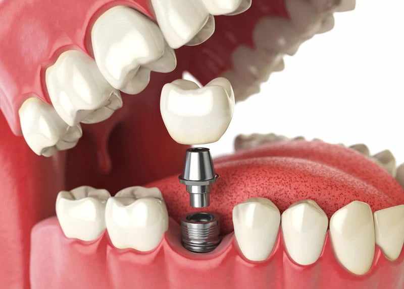Dental Implants: A Long-Lasting Solution for a Confident Smile in St. Albert