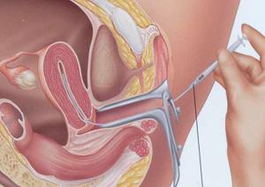 IVF Specialist in Nigdi: Dr. Bendale's Fertility Clinic