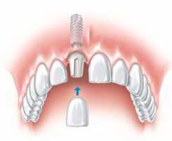 Rebuilding a Smile: The Advantages of Receiving Dental Implants in Oakville