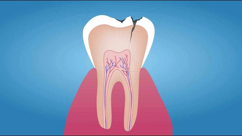 How long does it typically take to see results after a teeth whitening treatment at the dentist?