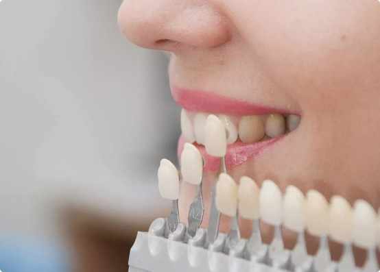 Is It Time for a Smile Upgrade? Explore Porcelain Veneers Melbourne