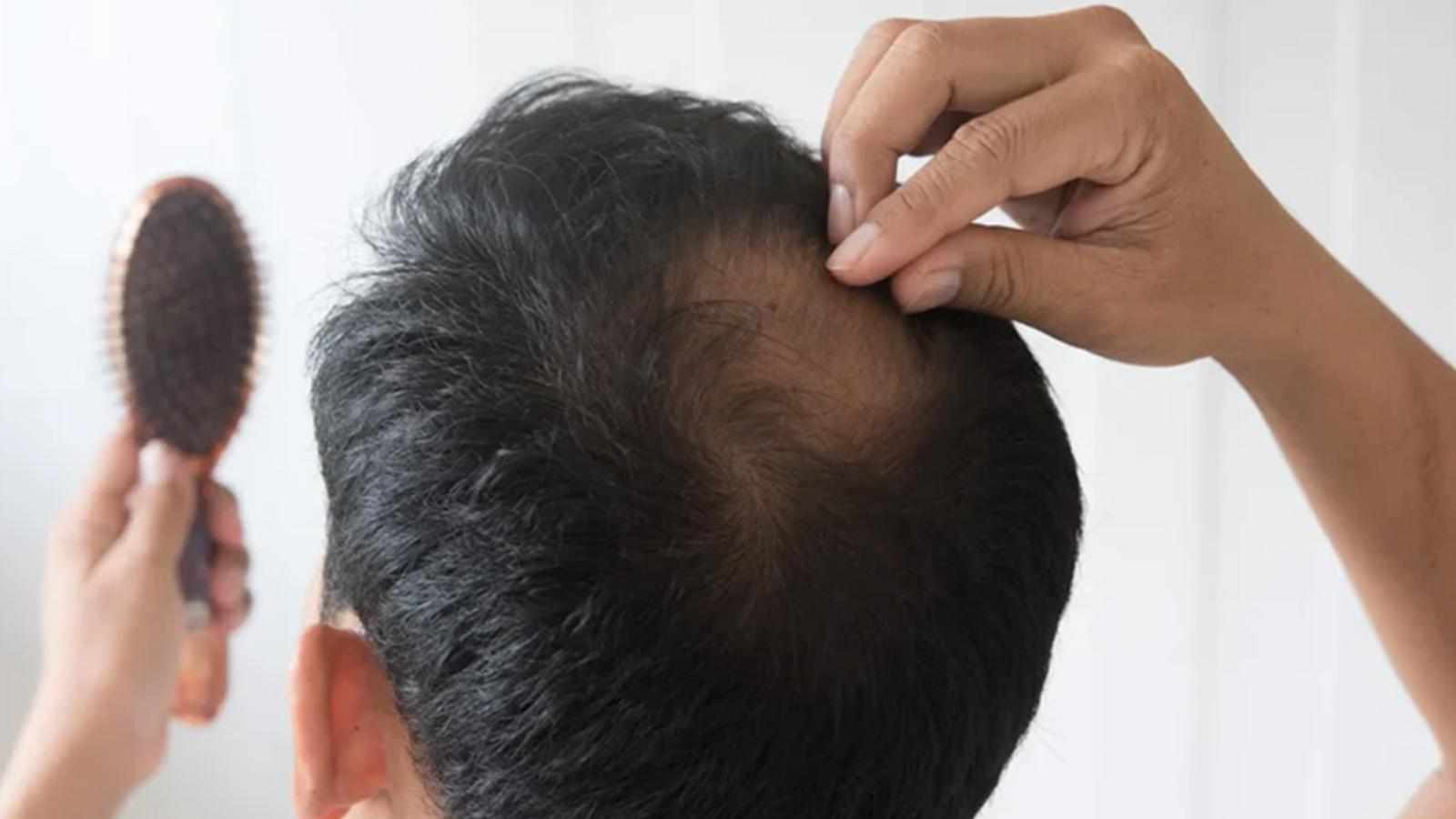 Best Hair Transplant Clinic in India: QHT Clinic Leads the Way