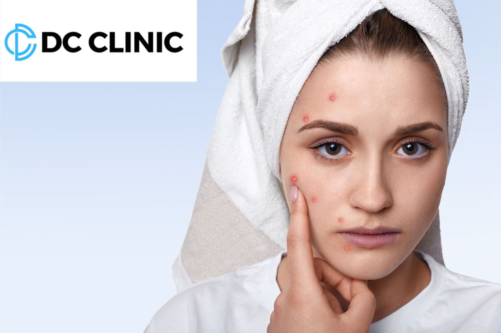 Effective Pimple Marks Treatment: A Comprehensive Guide to Clearer Skin
