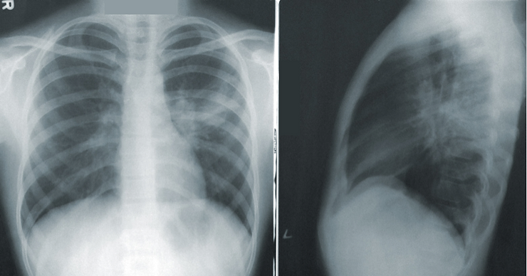 Early Speech-Language Pathology Consultation and Pneumonia After Cardiac Surgery