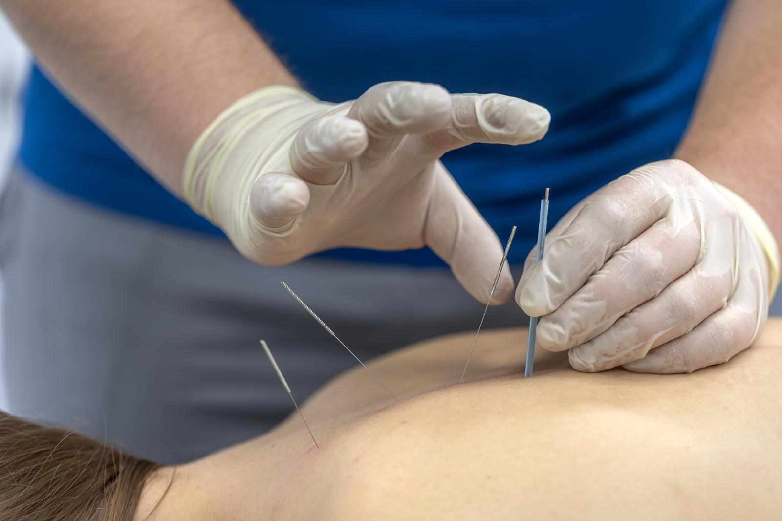 Acupuncture For Back Pain | Natural Pain Relief Treatment