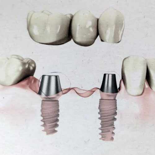 Dental Implant Clinic In South Delhi