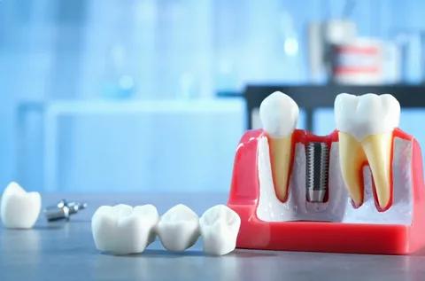 Best Dental Implants in Los Angeles – Restore Your Smile with Expert Care at Smile Again Dental Group