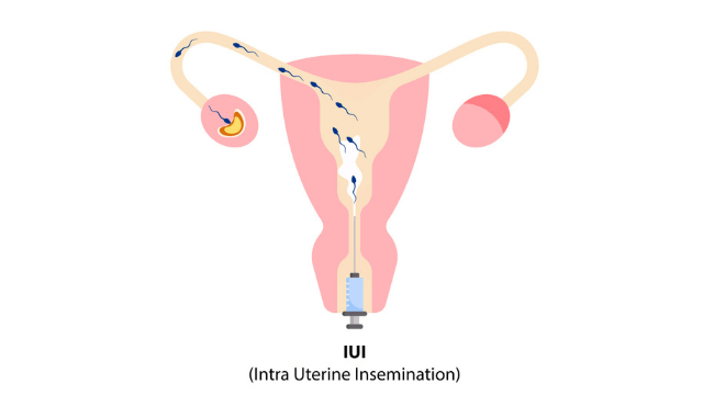What is the Success Rate for IUI Treatment?