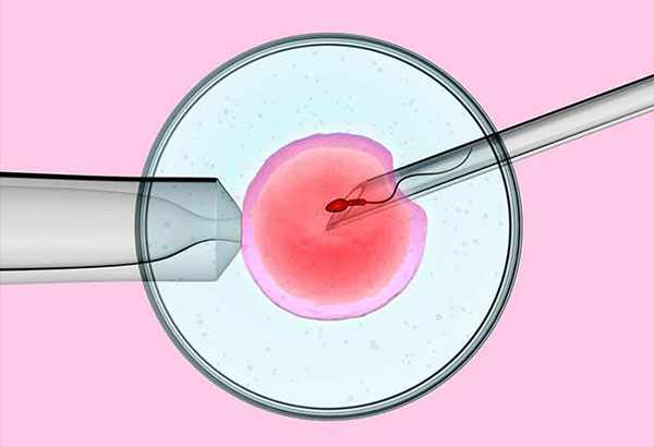 ICSI Fertility Treatment: Cost Breakdown and Ideal Candidates