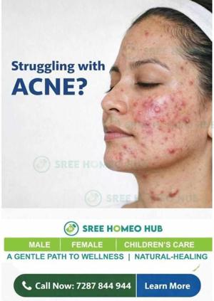 Struggling with pimples and acne?