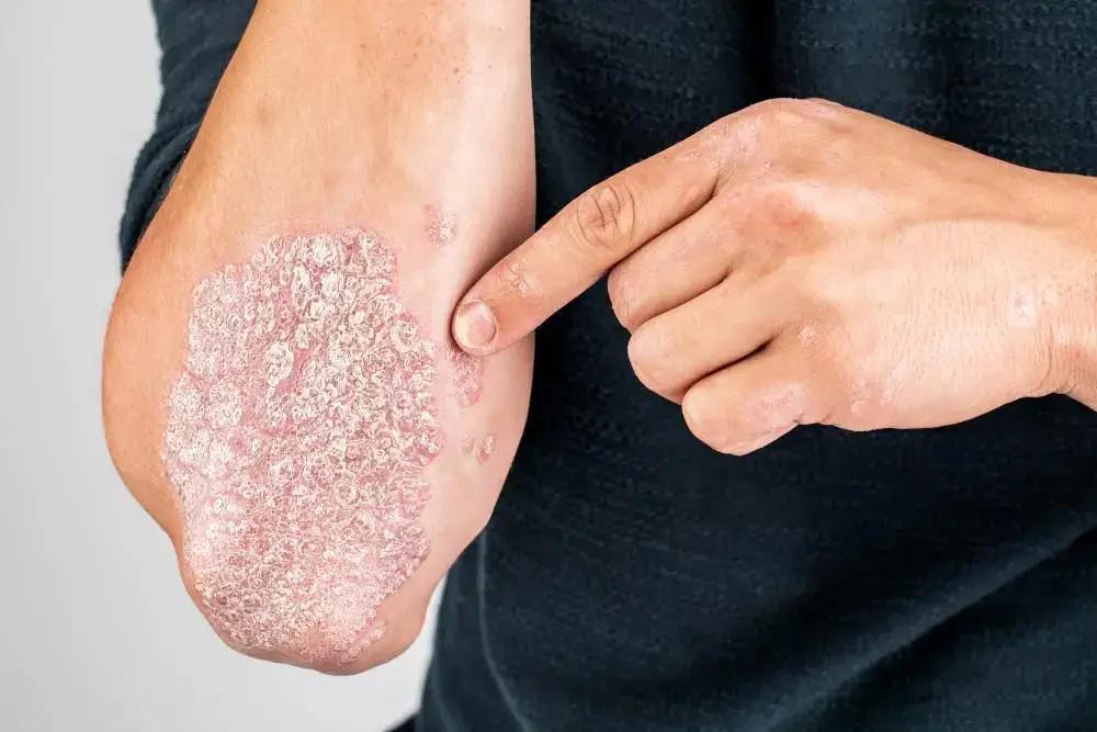 What Causes Psoriasis? Genetics, Immunity & Triggers