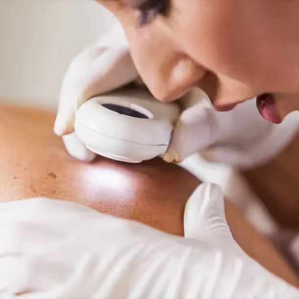 When Do You Need a Skin Biopsy?