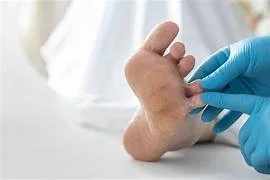 Home Remedies vs. Medical Anti-Fungal Treatment