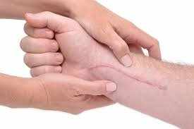 scar treatment for hand