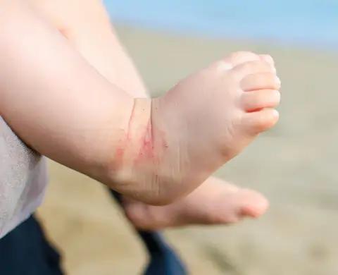 eczema-symptoms