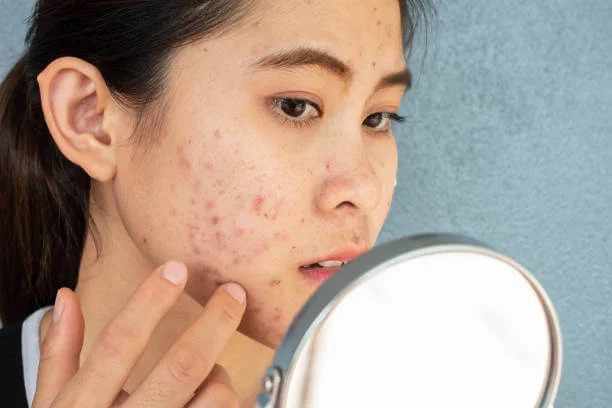Best Skincare After Acne Scar Treatment