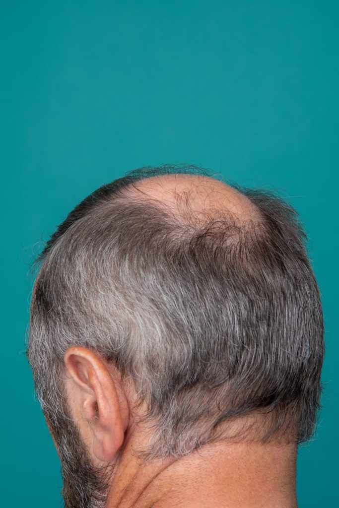 Dermatologists Explain Hair Loss Biopsy Results
